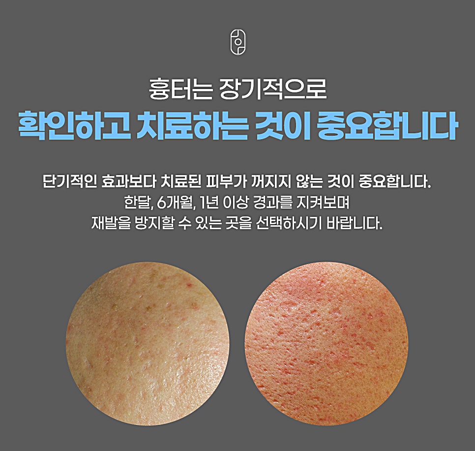 흉터는 장기적으로 확인하고 치료하는 것이 중요하다는 안내