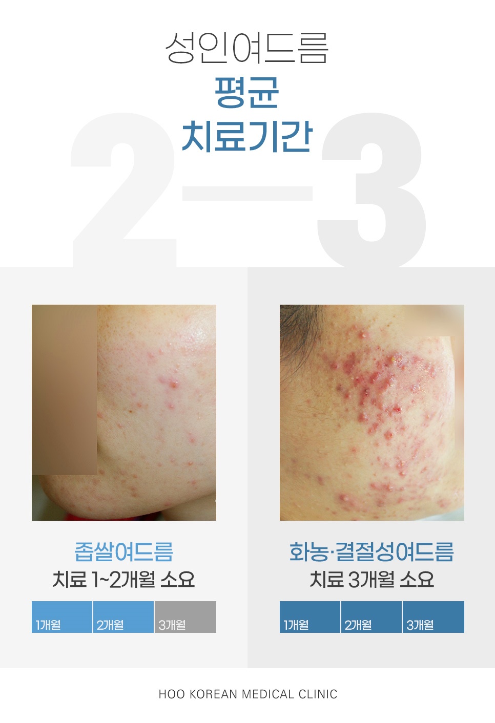 성인여드름 좁쌀여드름 화농결절성여드름 평균 치료기간 비교