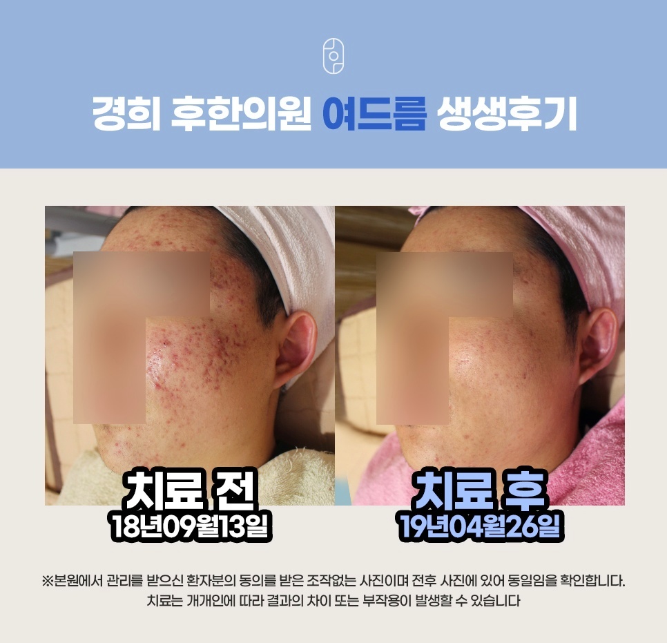 후한의원 원주점 볼여드름 치료 전후