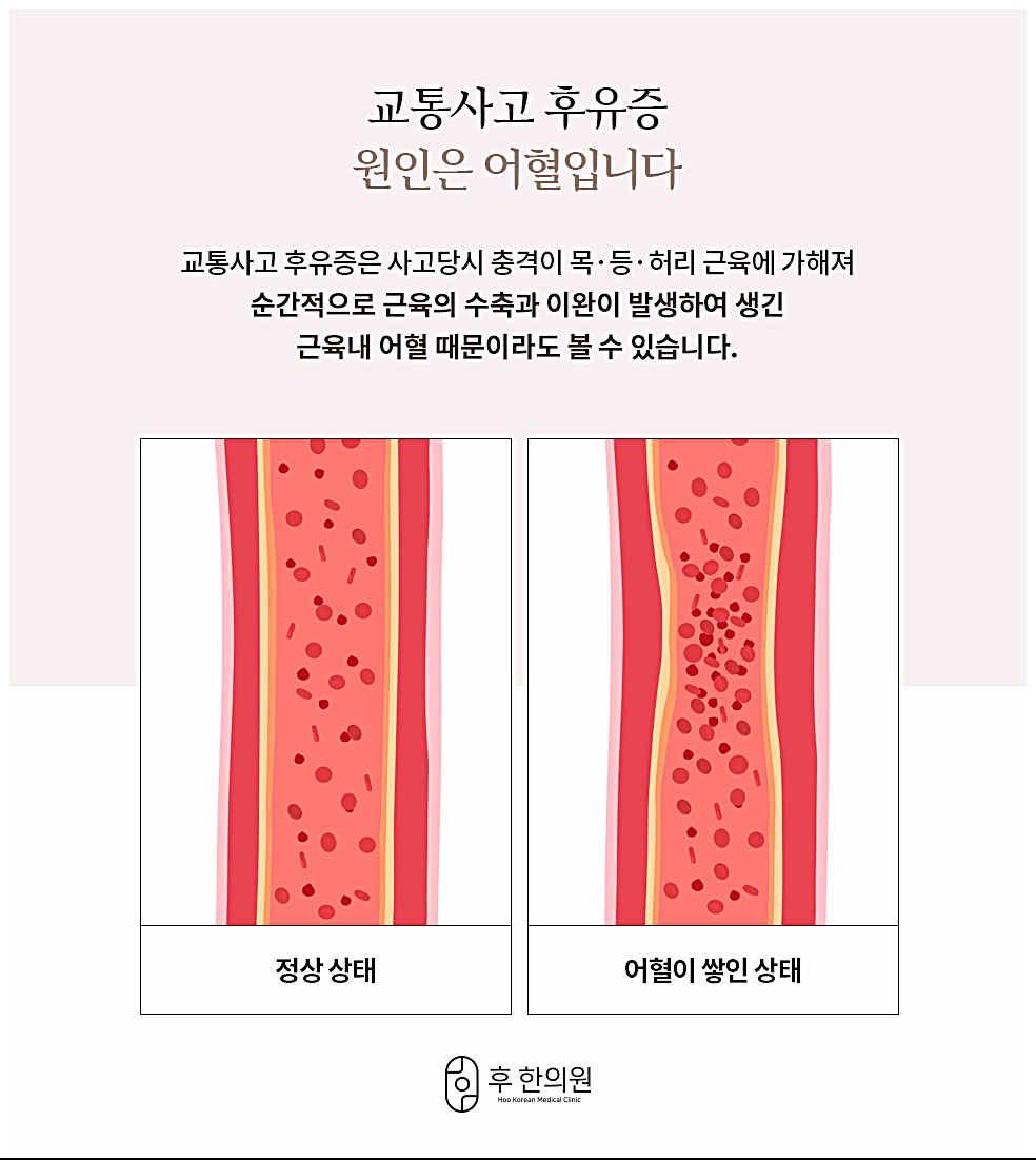 교통사고 후유증 원인 어혈에 대한 소개