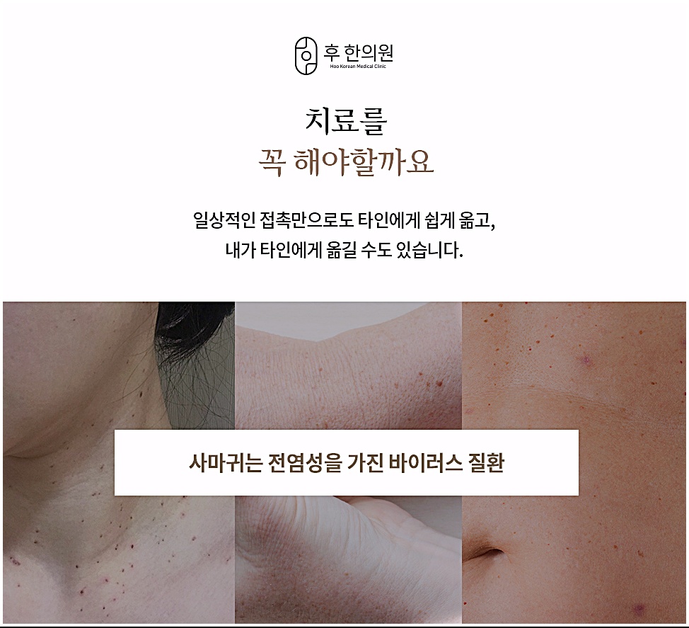 일상 접촉만으로도 전염될 수 있는 편평사마귀의 전염성 안내