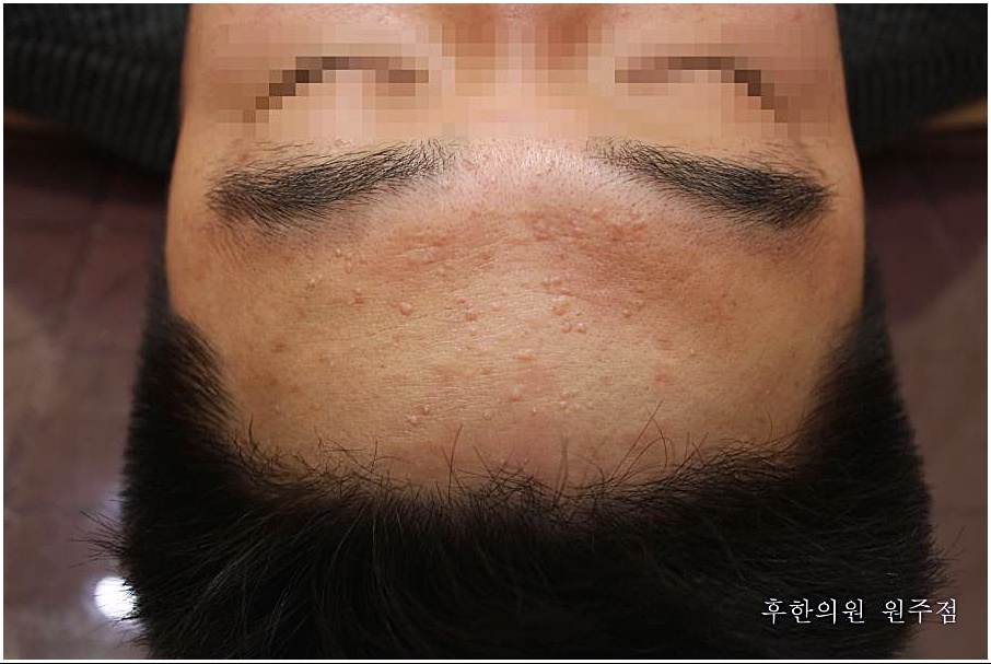 원주 편평사마귀 치료 전 이마 전반에 퍼진 편평사마귀 병변