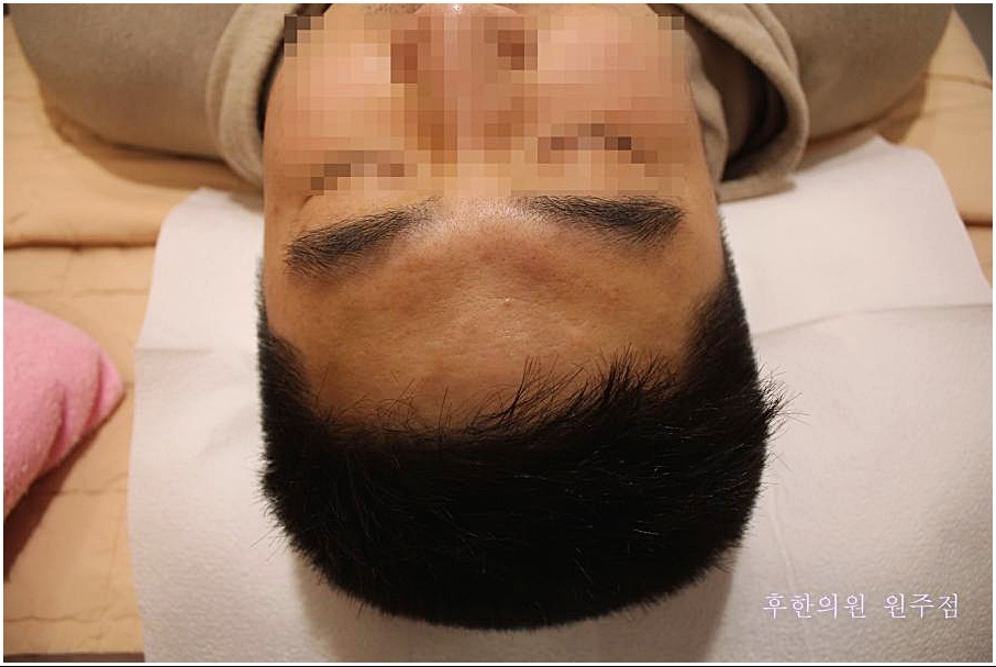 원주 편평사마귀 병변이 모두 제거되어 매끈해진 치료 후 이마