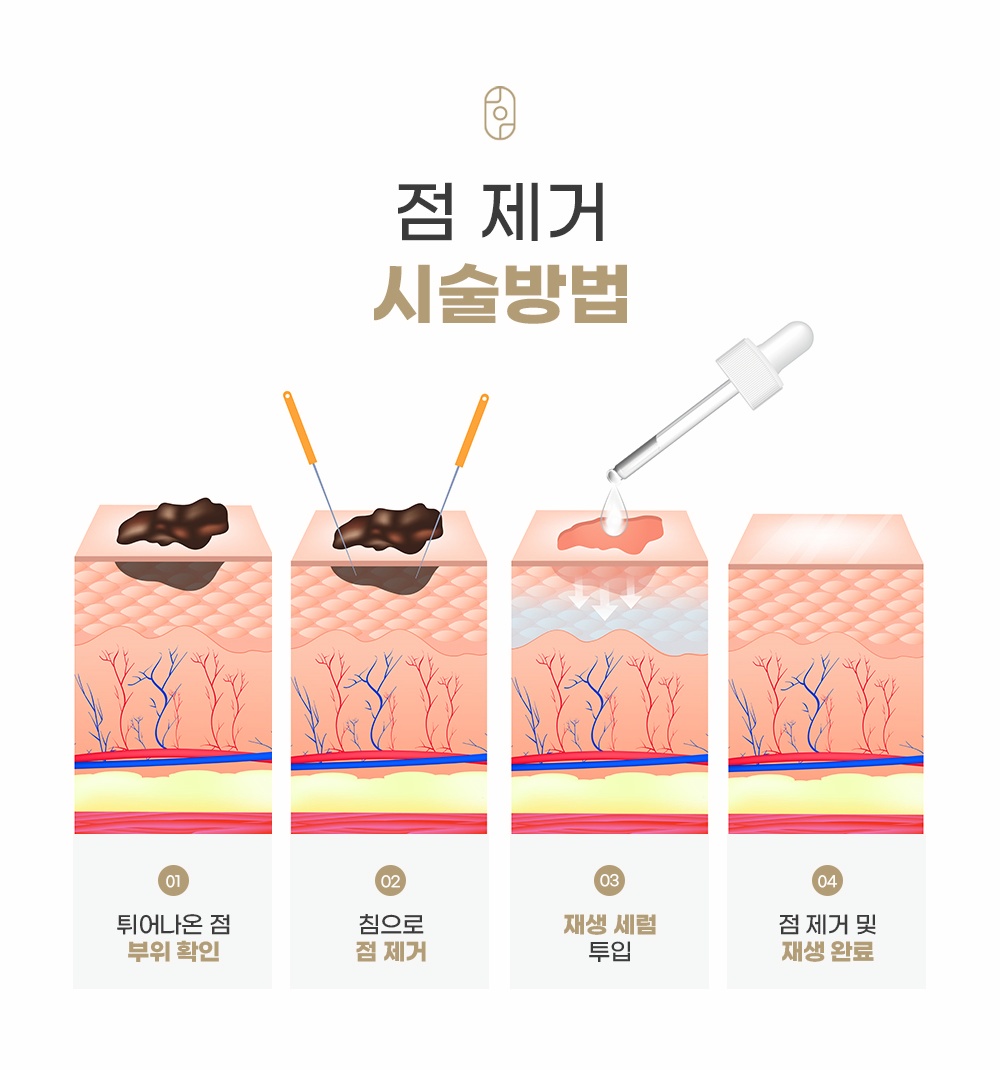 침을 이용한 튀어나온 점 제거 및 재생 세럼 투입 시술 단계 단계별 안내