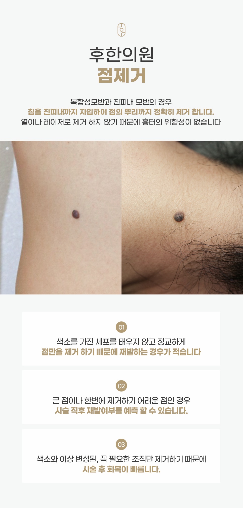 후한의원 침 자입 방식을 통한 뿌리 깊은 점 제거 장점 및 회복 과정 설명