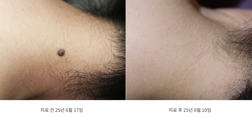 목 부위 큰 점 및 튀어나온 점 한방 치료 전후 경과 비교