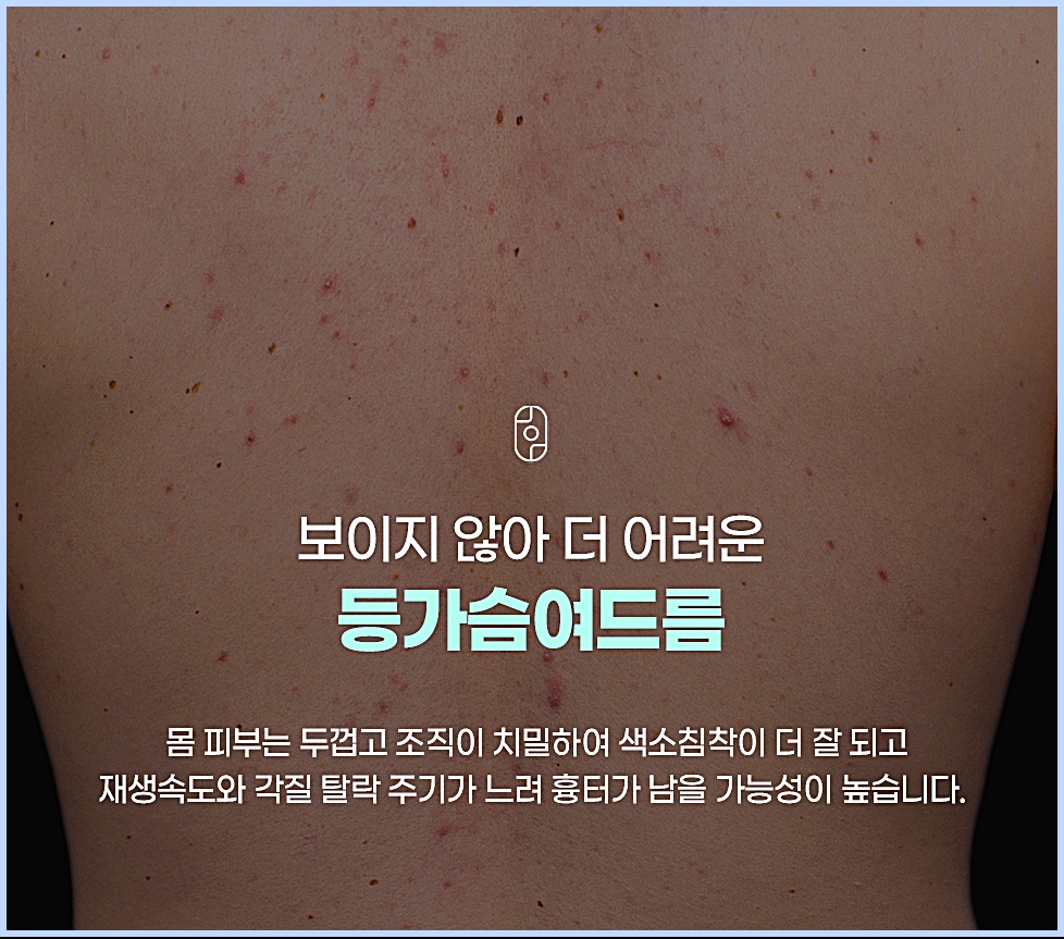 등과 가슴에 넓게 퍼진 등가슴여드름과 색소침착 병변