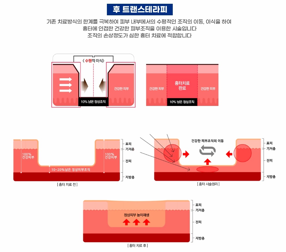 트랜스테라피 수평 조직 이식 및 새살 재생 원리