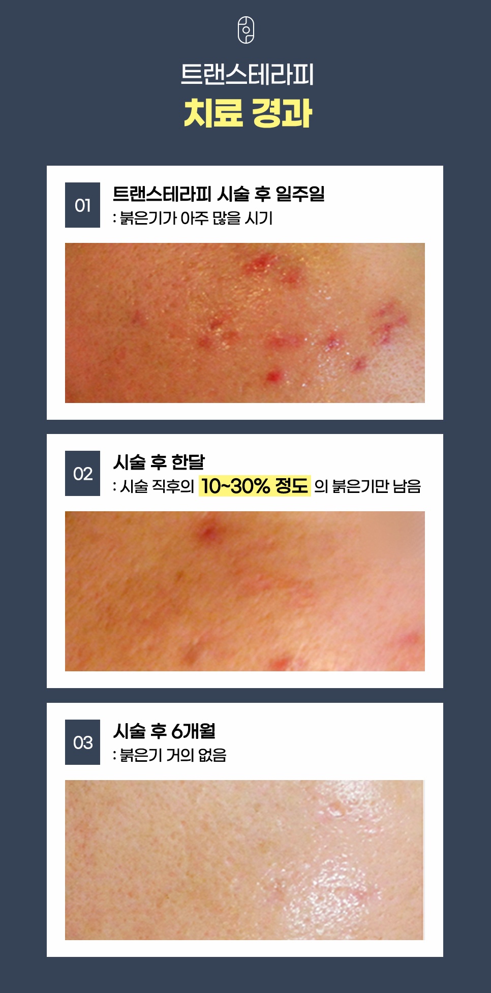 트랜스테라피 시술 후 일주일, 한 달, 6개월 차 피부 경과 변화