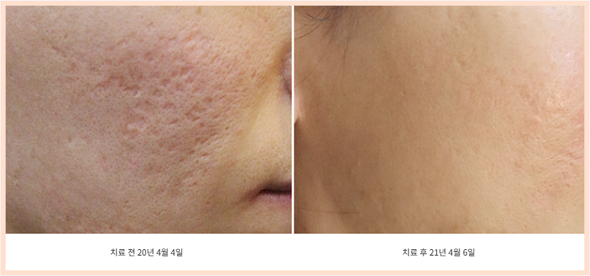 흉터 치료 전후