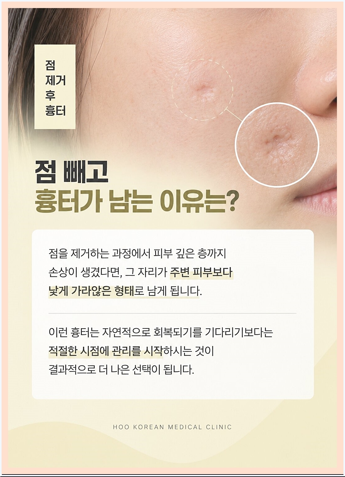 점빼고 흉터가 남는 원인 이미지