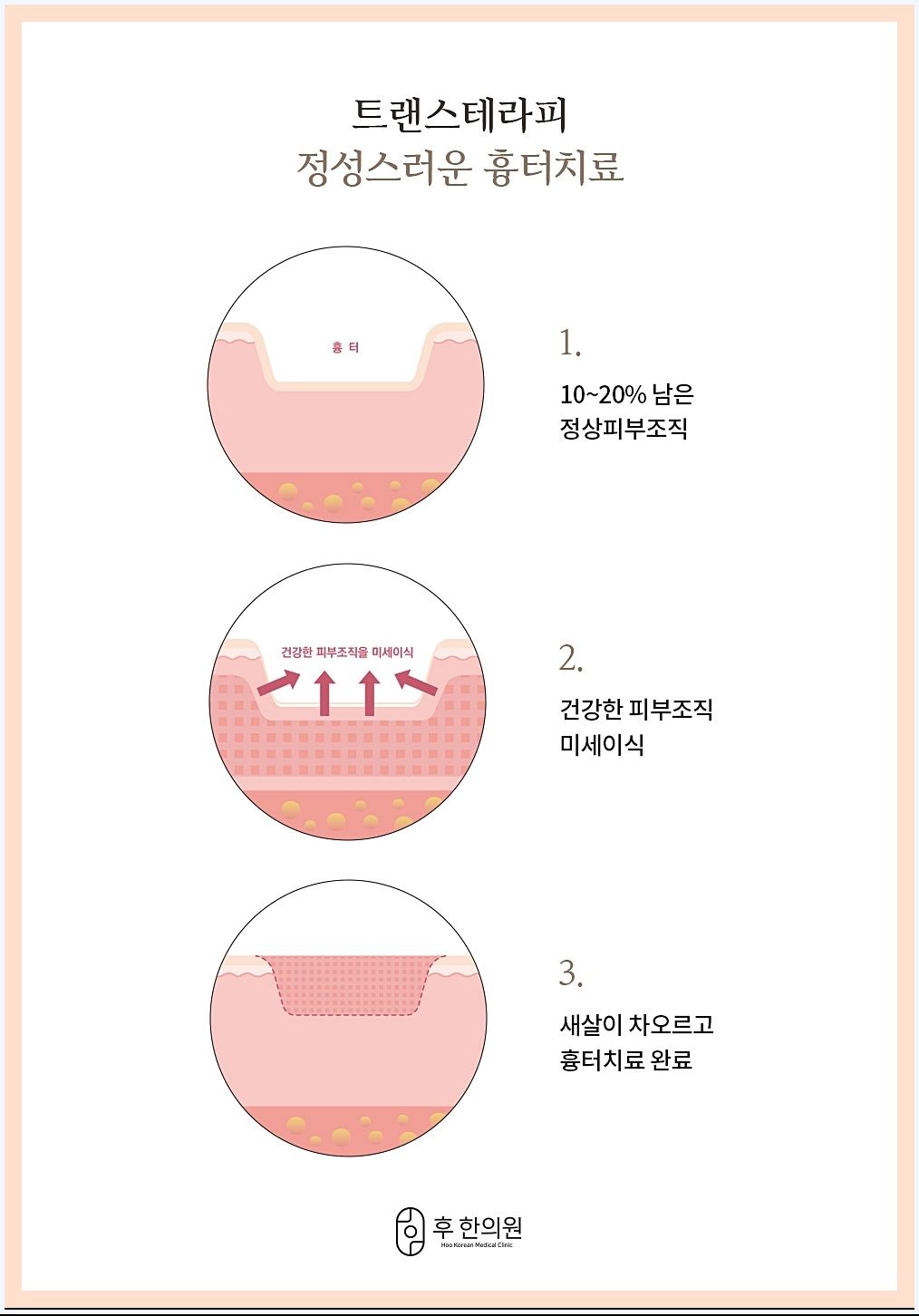 트랜스테라피 치료 과정