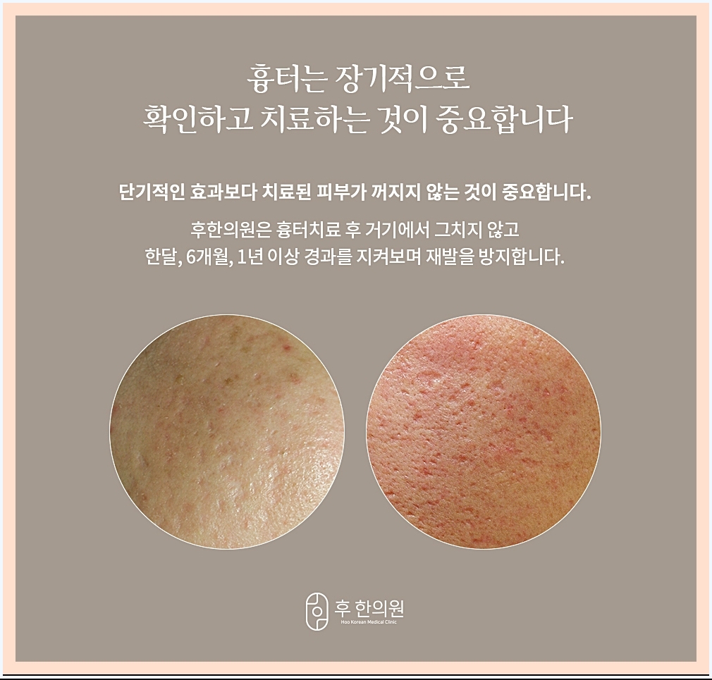 원주점뺀흉터 치료 관찰의 중요성