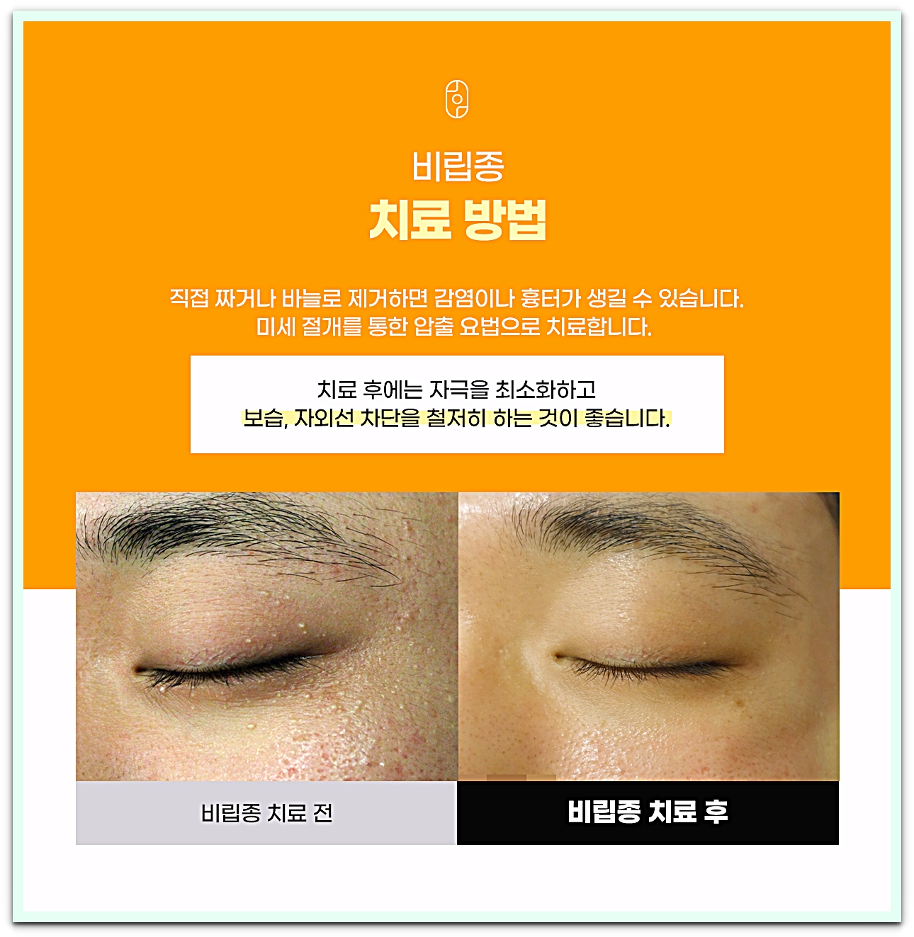 원주비립종 미세 절개 압출 치료 방법과 치료 전후 눈가 피부 비교
