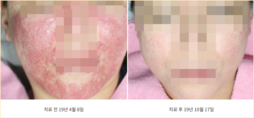 원주지루피부염 얼굴 전체 치료 전후