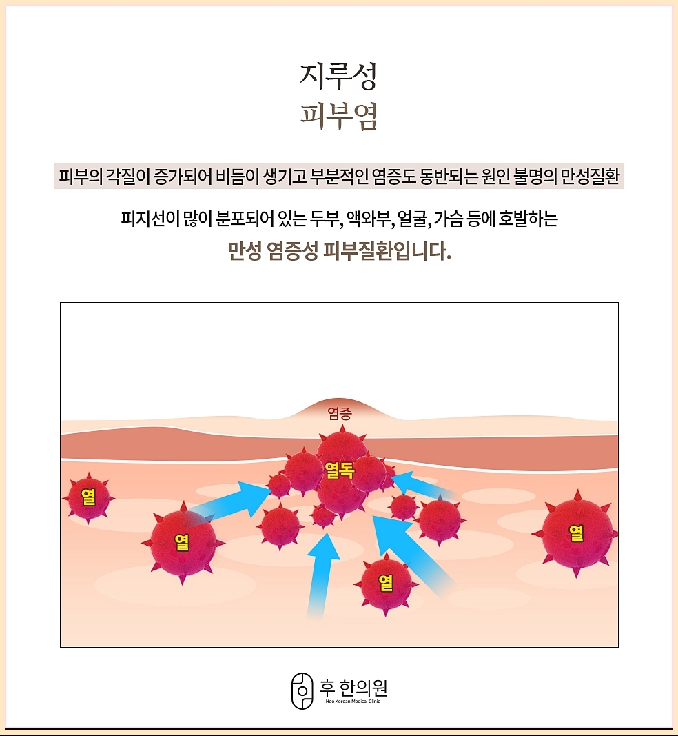 원주지루피부염 지루성피부염의 정의