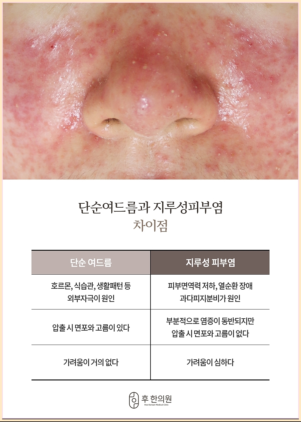 지루피부염과 혼동하기 쉬운 질환 정리표