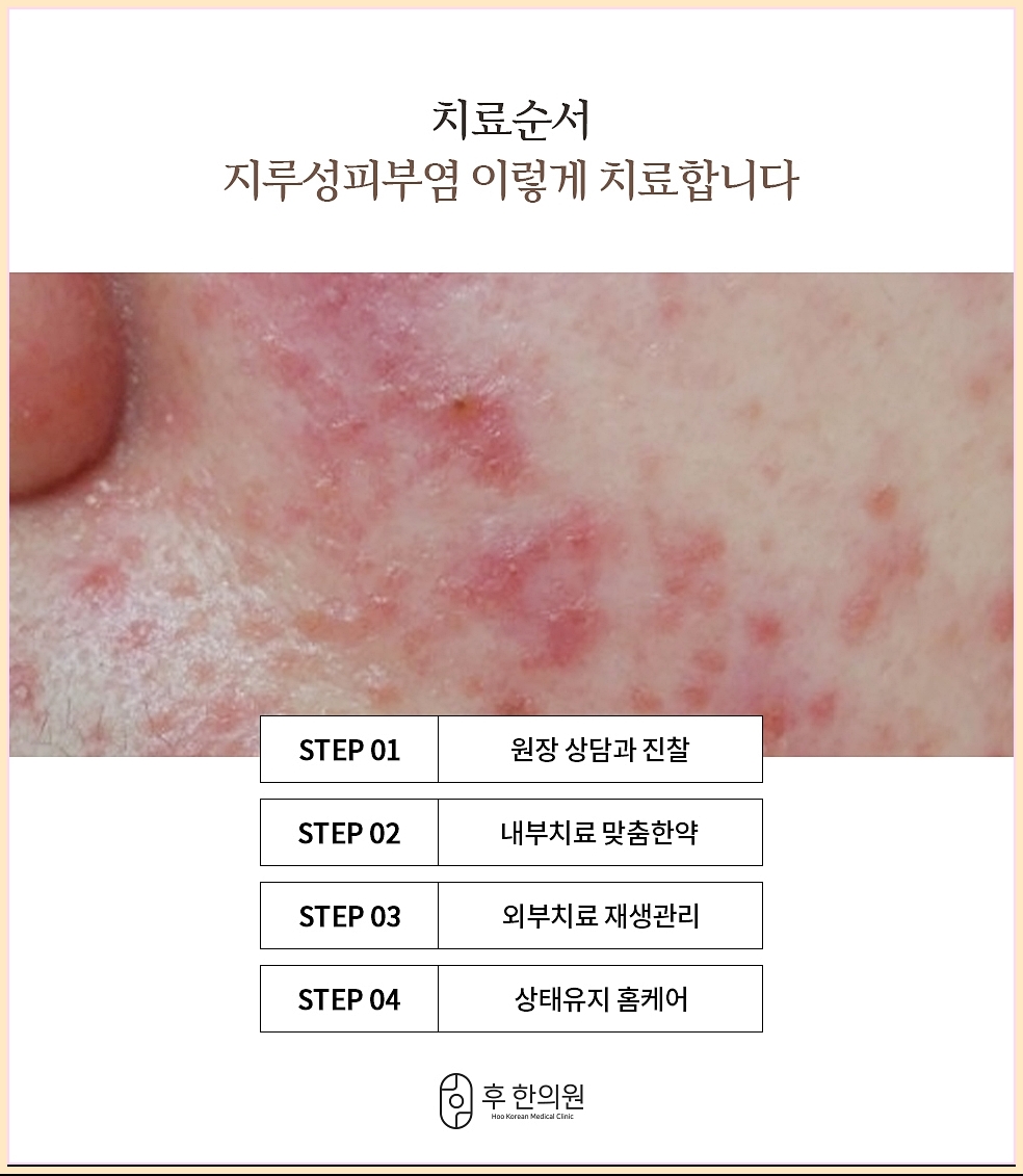 원주지루피부염 치료 순서 정리 이미지