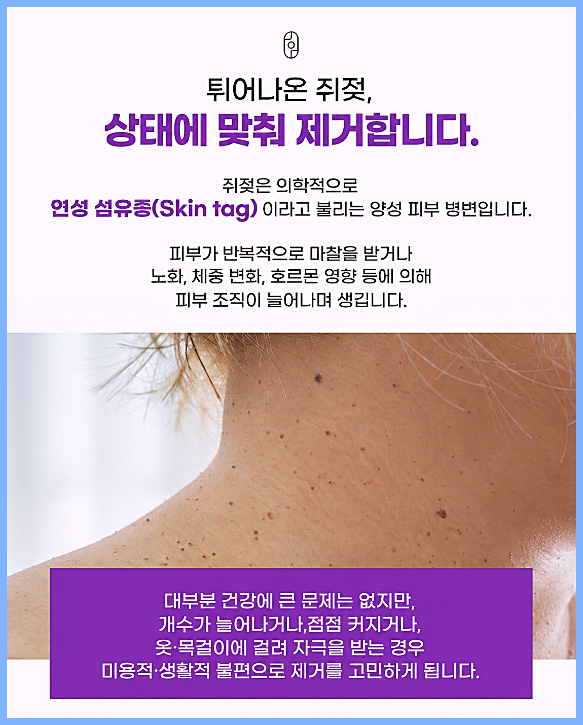 원주쥐젖 제거를 고민하게 되는 이유와 연성 섬유종을 설명