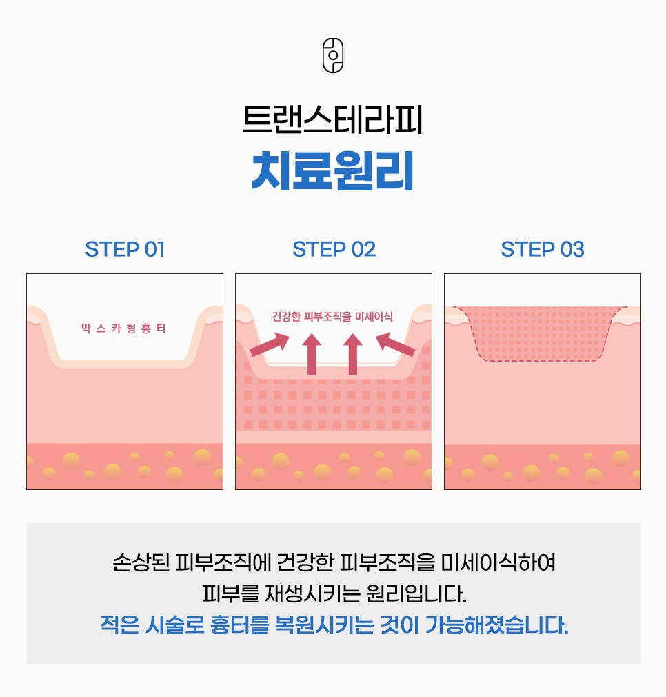 원주파인흉터 트랜스테라피 치료원리
